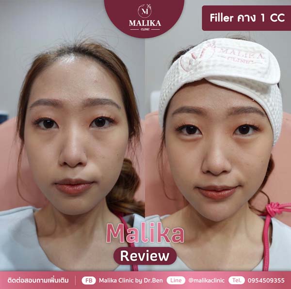 Filler คาง review malika clinic