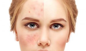 treatment acne