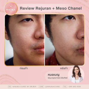 Meso_Rejuran1