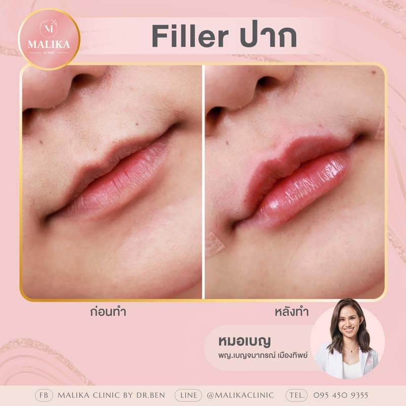 filler lips before after