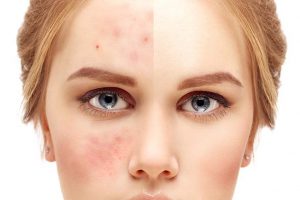 treatment acne